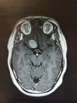 MRI head scan with tumour